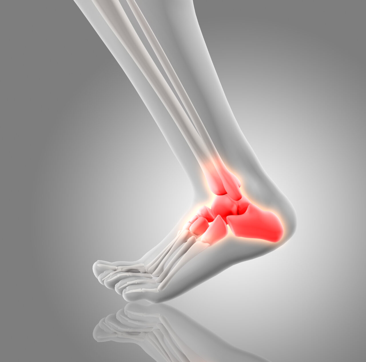 Achilles Tendinitis: Causes, Symptoms, and Effective Treatments