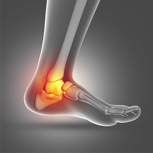 A foot with an ankle sprain condition