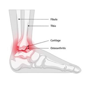 A foot with an arthritis condition