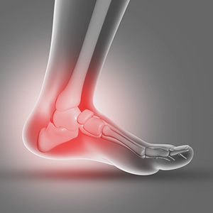 A foot with an ankle sprain condition