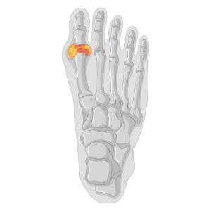 A foot with a bunions condition