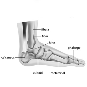 A foot suffering from a Charcot foot condition