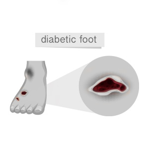 A person suffering from a diabetic foot condition