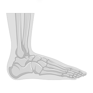 A foot with a flat feet condition