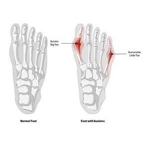 A foot suffering from a foot deformity condition