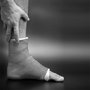 A foot with a fractured foot condition