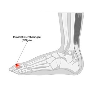 A foot with a Heel Pain condition