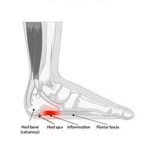 A foot with a Heel Pain condition