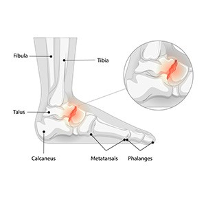 A foot with a lisfranc injury condition