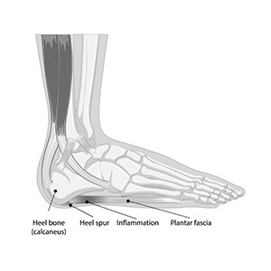 A foot with a plantar fasciitis condition