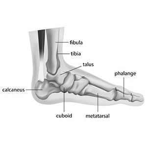 A foot with a tarsal coalition condition