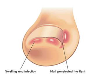 Best Doctor for Ingrown Toenail