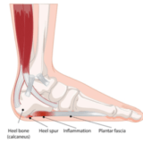 Best Treatment For Plantar Fasciitis