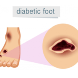 Diabetic Foot Treatment