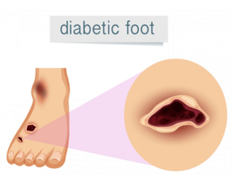 Diabetic Foot Treatment