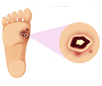 best treatment for foot ulcers