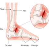 Lisfranc Injury Treatment