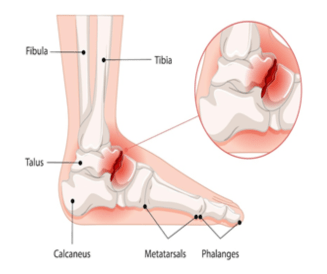 A Misstep That Changes Everything: Understanding & Treating Lisfranc Injuries
