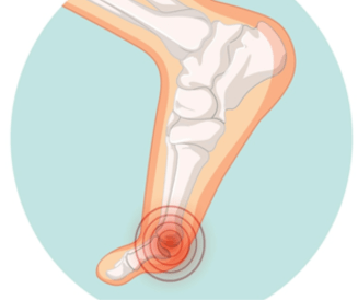 Foot Drop Specialist