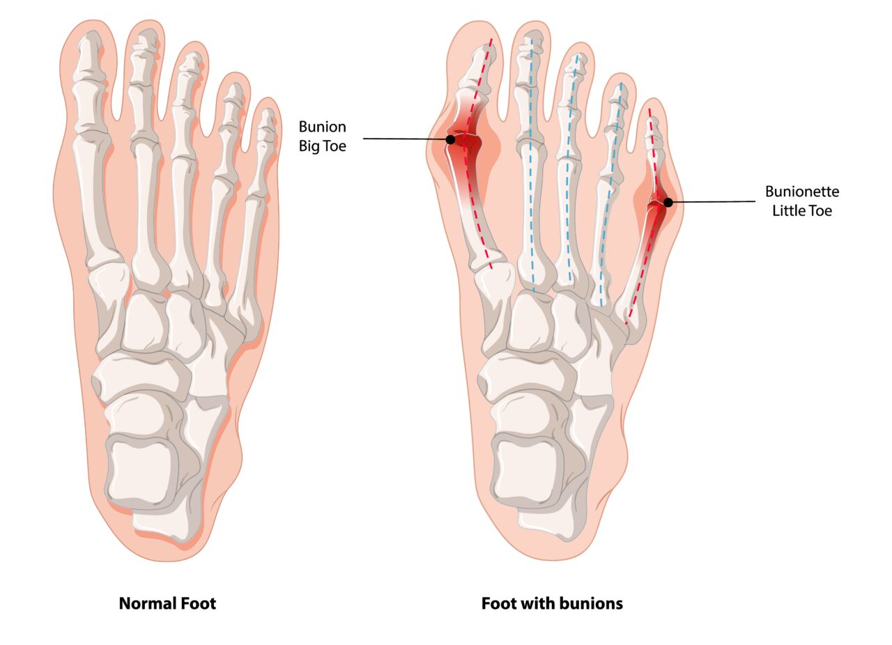 Bunion Treatment, Correction, and Surgery by Expert Foot and Ankle Specialist