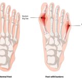 bunion correction