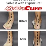 Hyprocure® – Minimally Invasive Solution to fix the misaligned feet
