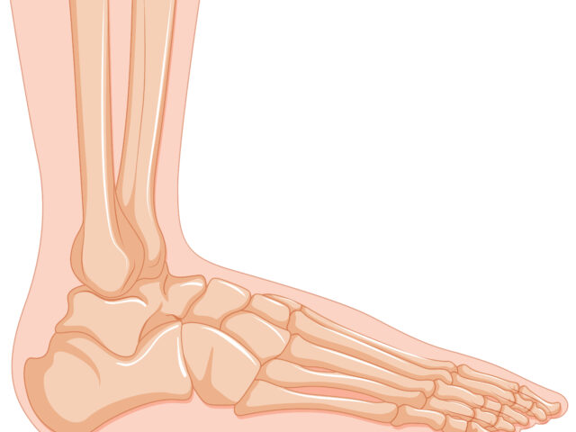 Treatment of flat foot